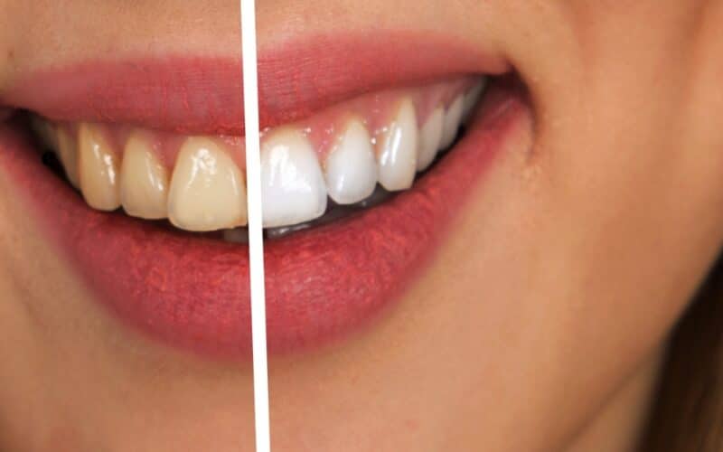 Descubra qual clareamento dental usar em casa: V34, Oralhoe ou peróxido? Compare eficácia, segurança e saúde bucal. Guia completo e atual!